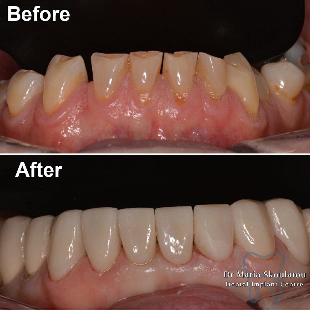 Porcelain Veneers Result