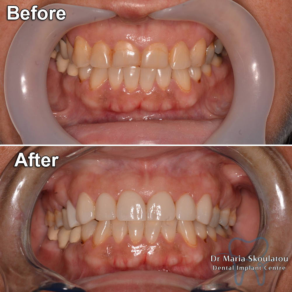 Porcelain Veneers Result