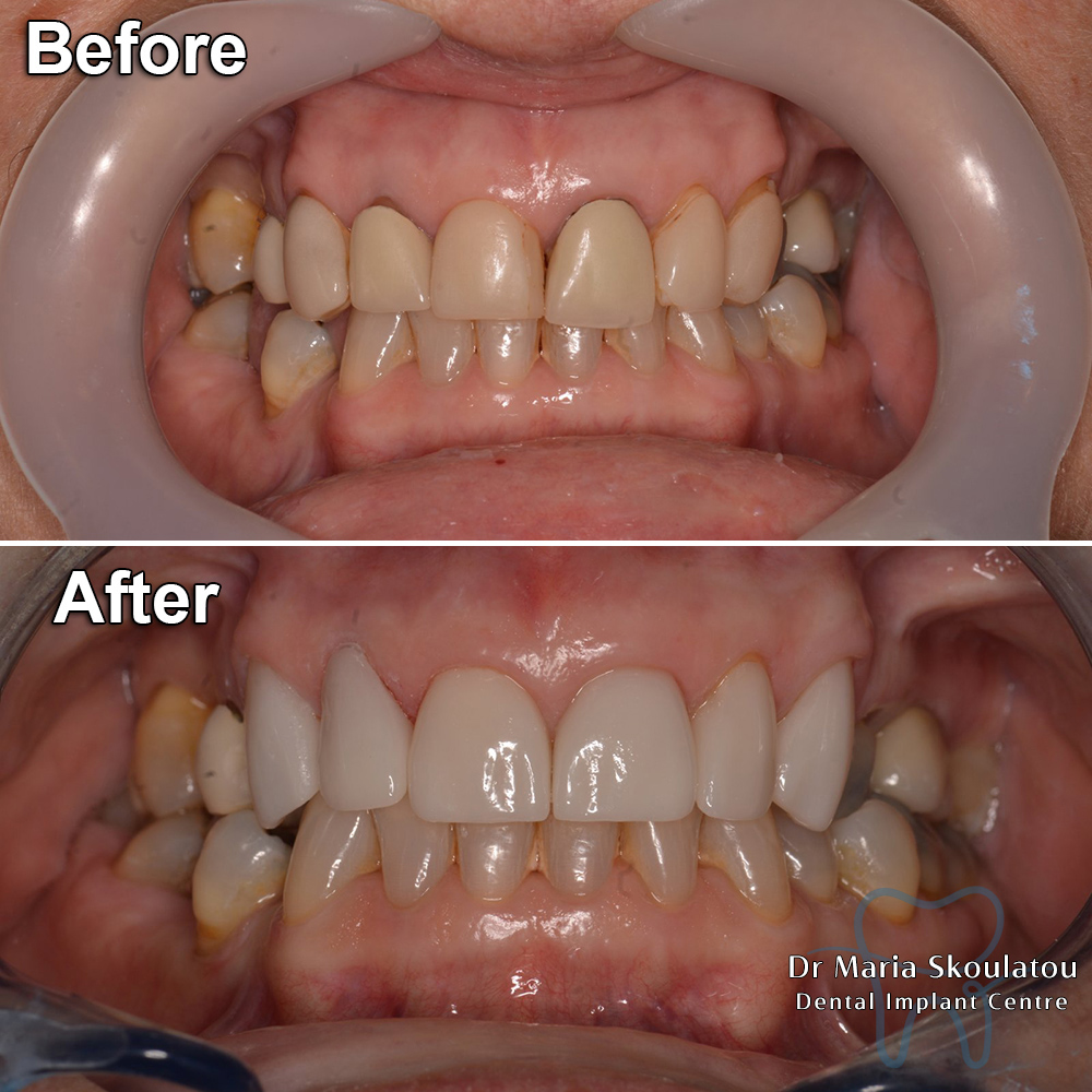 Porcelain Veneers Result