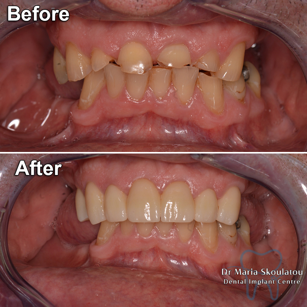 Porcelain Veneers Result