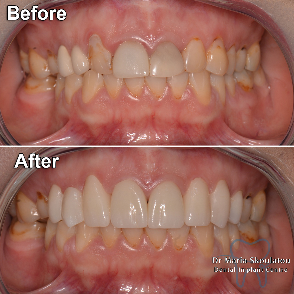 Porcelain Veneers Result