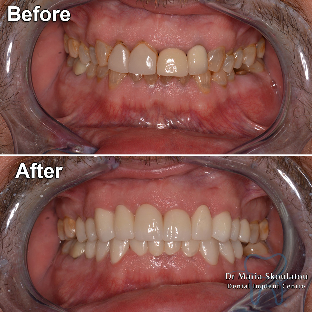 Porcelain Veneers Result