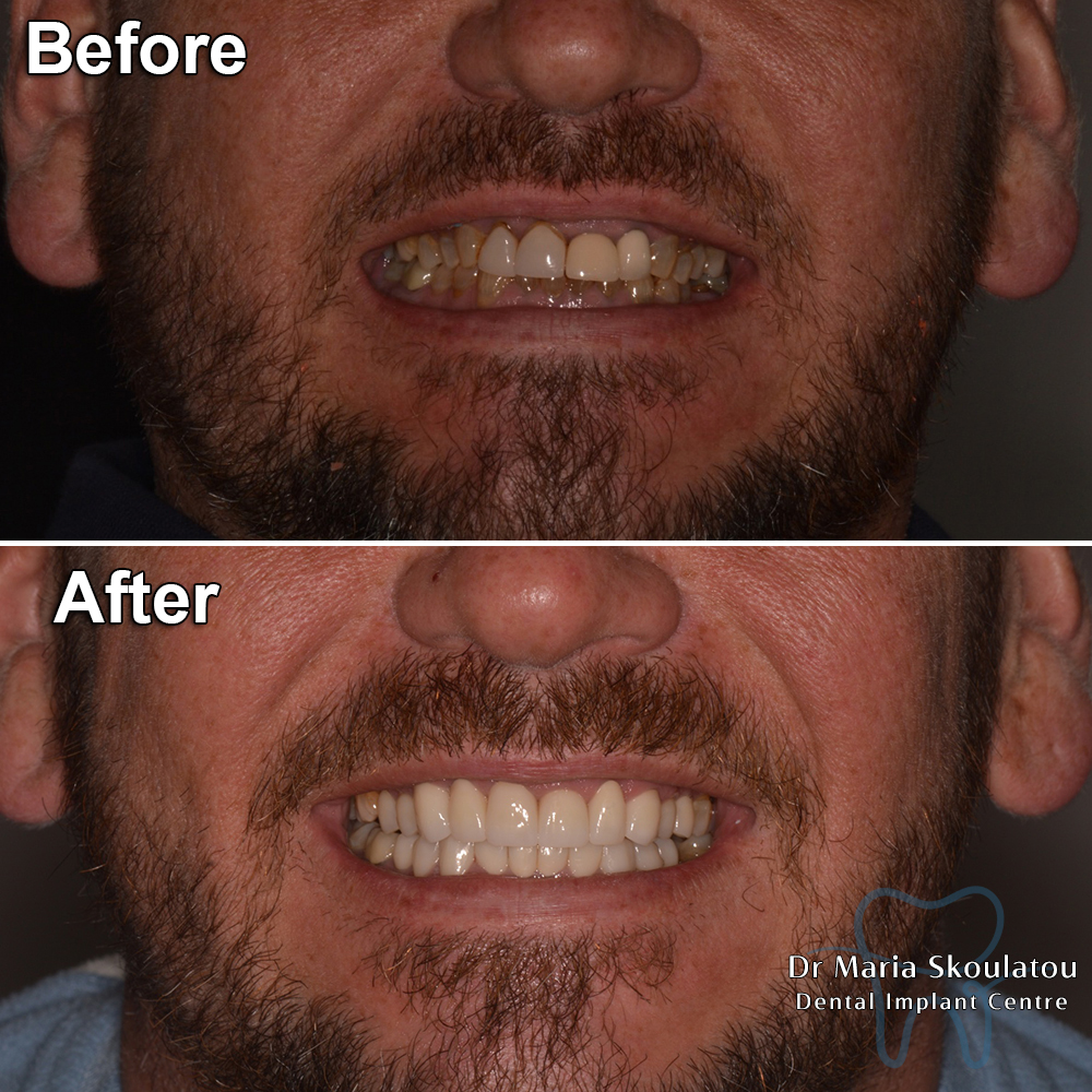 Porcelain Veneers Result