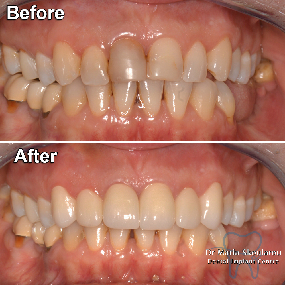 result28before-after