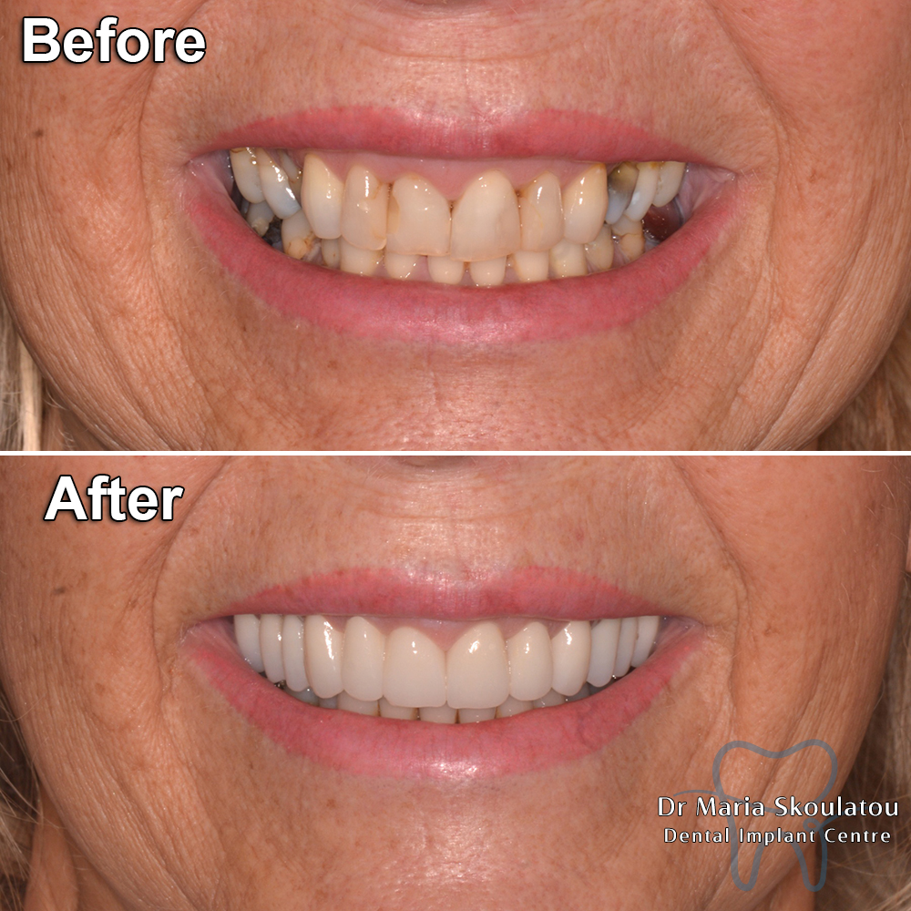 result29beforeafter-veneers-smile