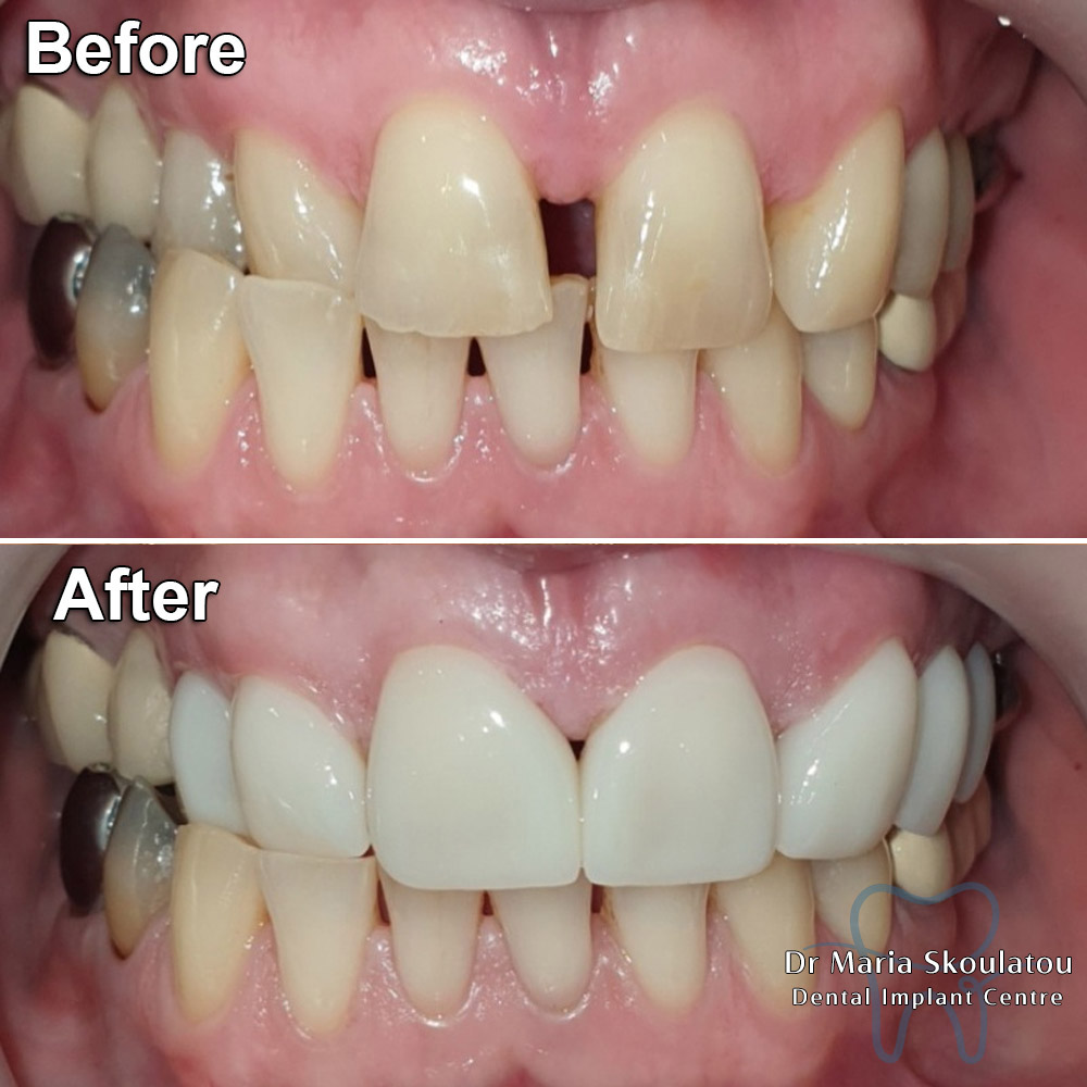 Porcelain Veneers Result