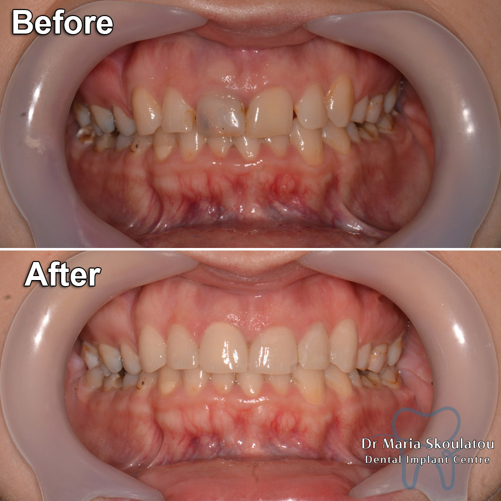 Porcelain Veneers Result