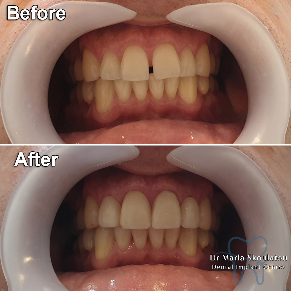 Porcelain Veneers Result