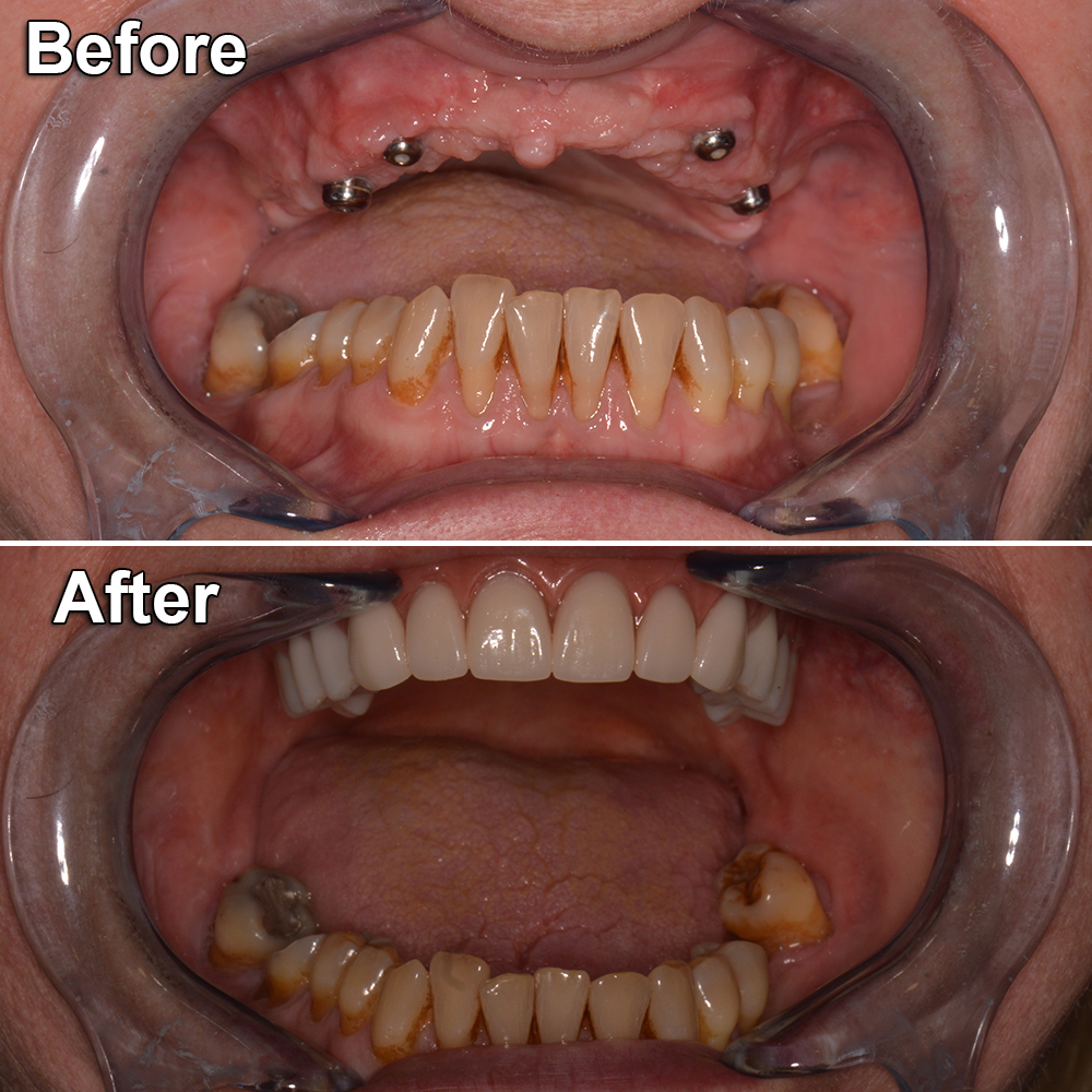 before after dental implants