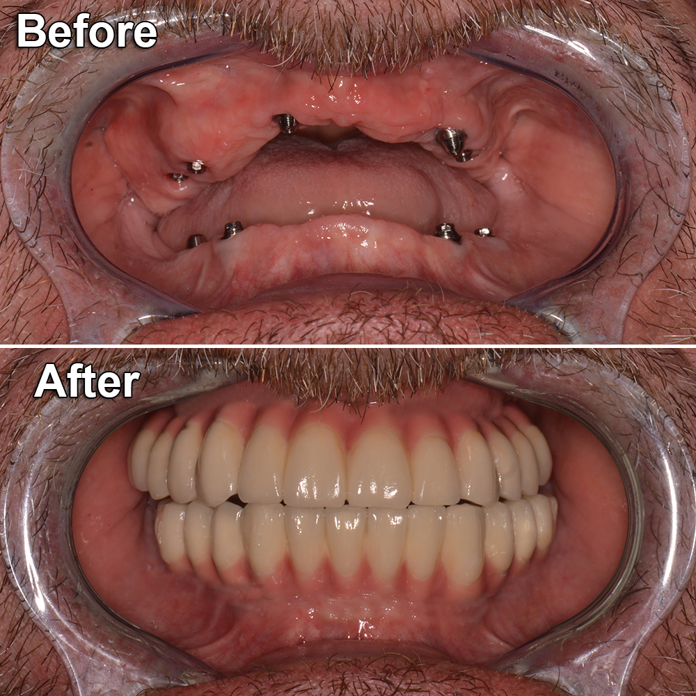 before after dental implants